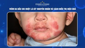 Viêm da đầu chi ruột