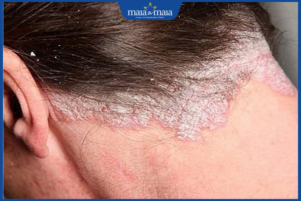 Viêm da dầu: Triệu chứng, chẩn đoán, điều trị và phòng ngừa 5 Viêm da dầu gây rụng tóc