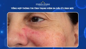 viêm da dầu ở cánh mũi