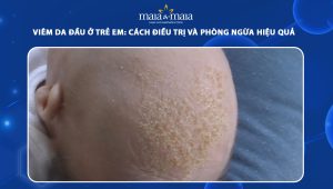 viêm da đầu ở trẻ em