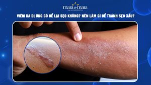 Viêm da dị ứng có để lại sẹo không