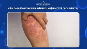 viêm da dị ứng kinh niên
