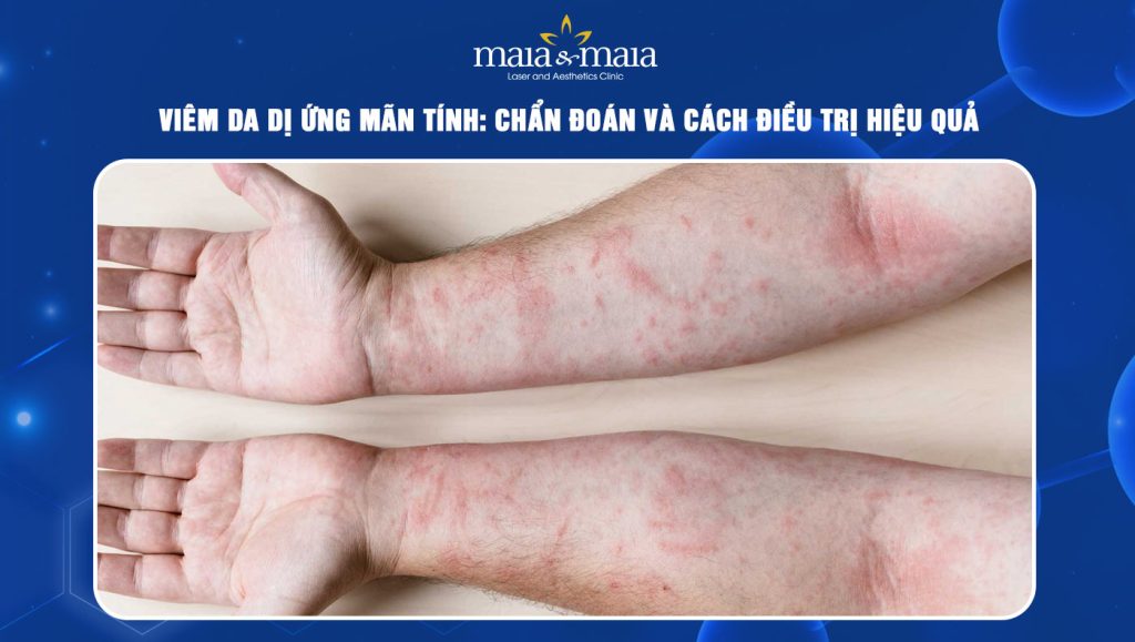 viêm da dị ứng mãn tính