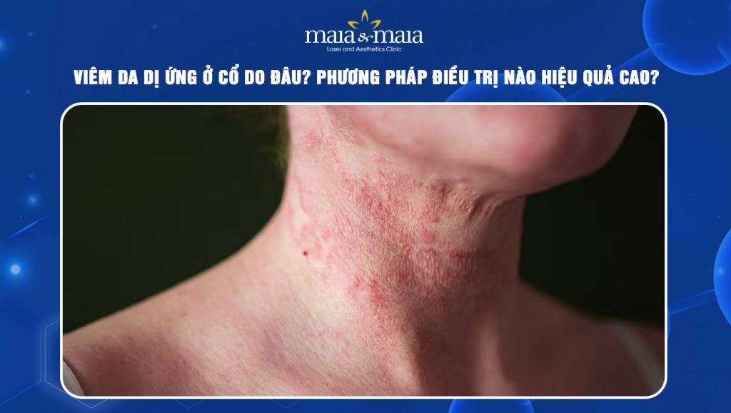 viêm da dị ứng ở cổ