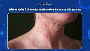 viêm da dị ứng ở cổ