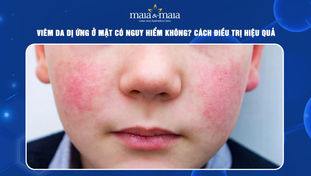 Viêm da dị ứng ở mặt có nguy hiểm không? Cách điều trị 1 Viêm da dị ứng ở mặt