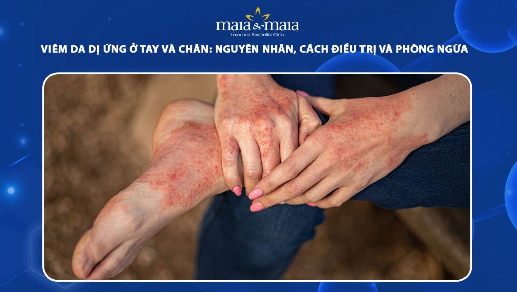 viêm da dị ứng ở tay và chân