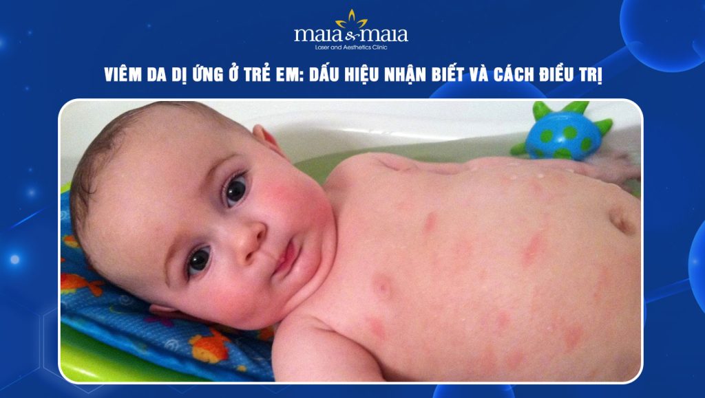 viêm da dị ứng ở trẻ em