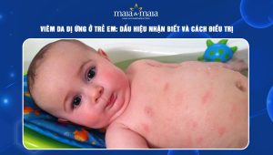 viêm da dị ứng ở trẻ em