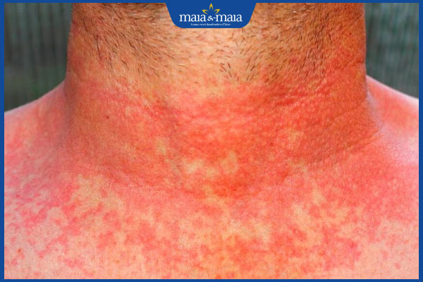 Viêm da dị ứng: Triệu chứng, nguyên nhân và cách điều trị 4 viêm da dị ứng quanh cổ