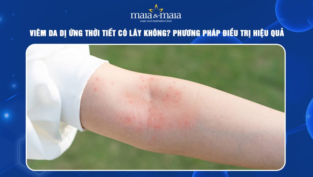 Viêm da dị ứng thời tiết có lây không? Điều trị như thế nào? 1 viêm da dị ứng thời tiết