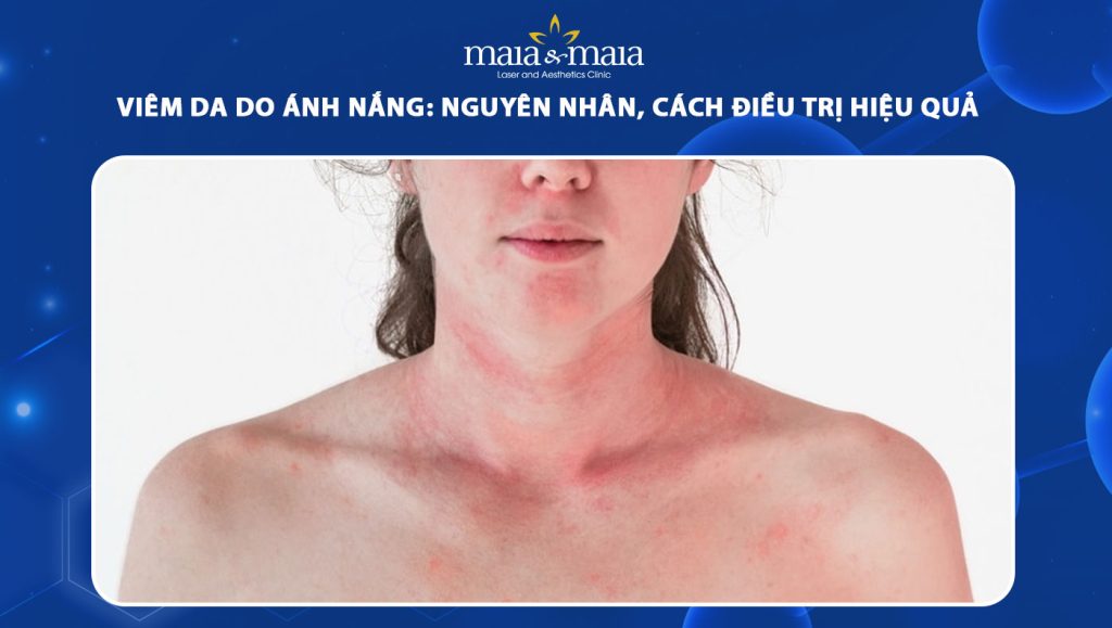 Viêm da do ánh nắng: Nguyên nhân, cách điều trị hiệu quả 1 viêm da do ánh nắng