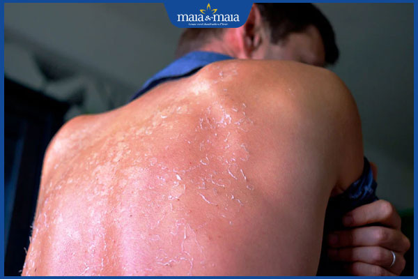 Viêm da do ánh nắng: Nguyên nhân, cách điều trị hiệu quả 3 viêm da do ánh nắng bị bong tróc