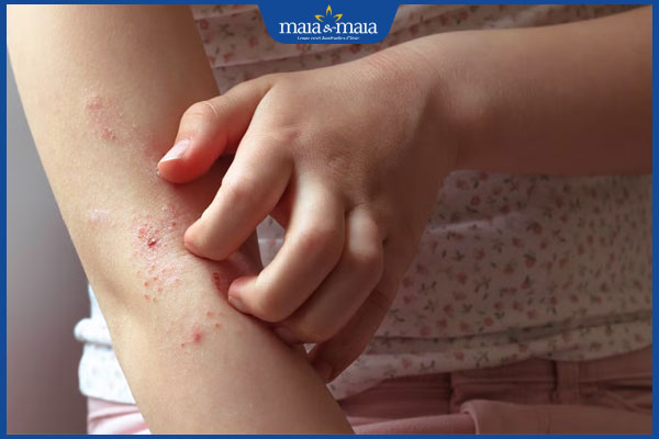 viêm da do ký sinh trùng