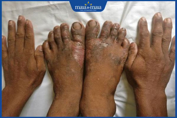 viêm da do xi măng