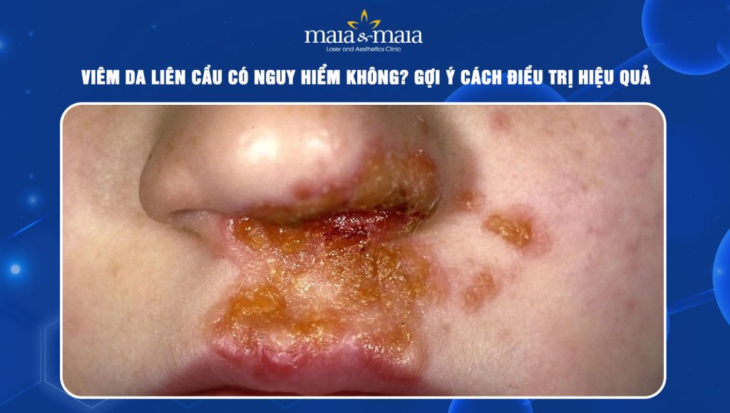 Viêm da liên cầu