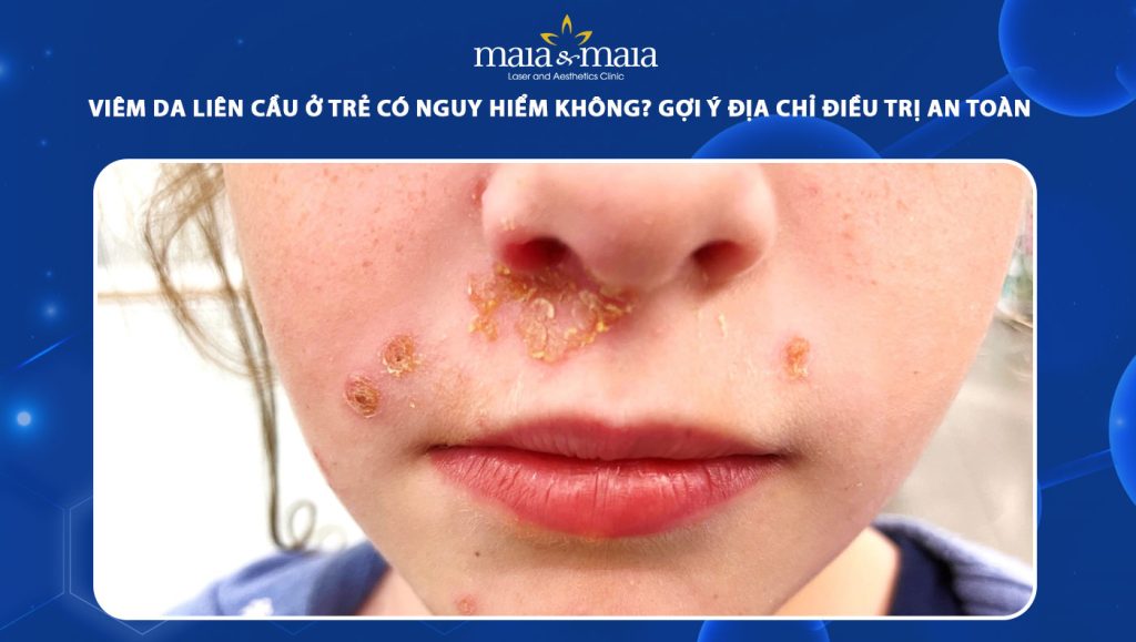 viêm da liên cầu