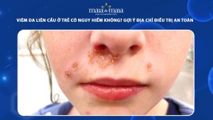 viêm da liên cầu