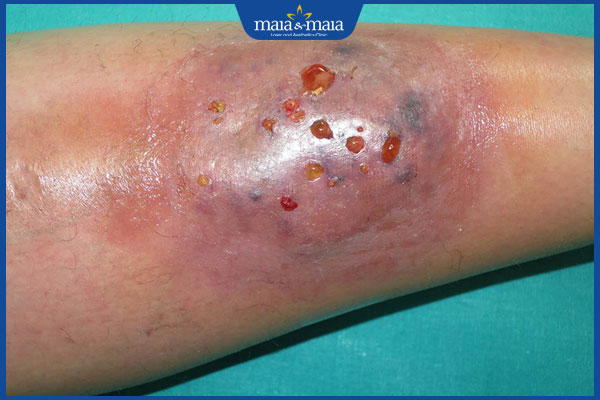 Tổng hợp danh sách 8 loại thuốc bôi trị viêm da mủ hiệu quả 7 viêm da mủ bị hoại tử