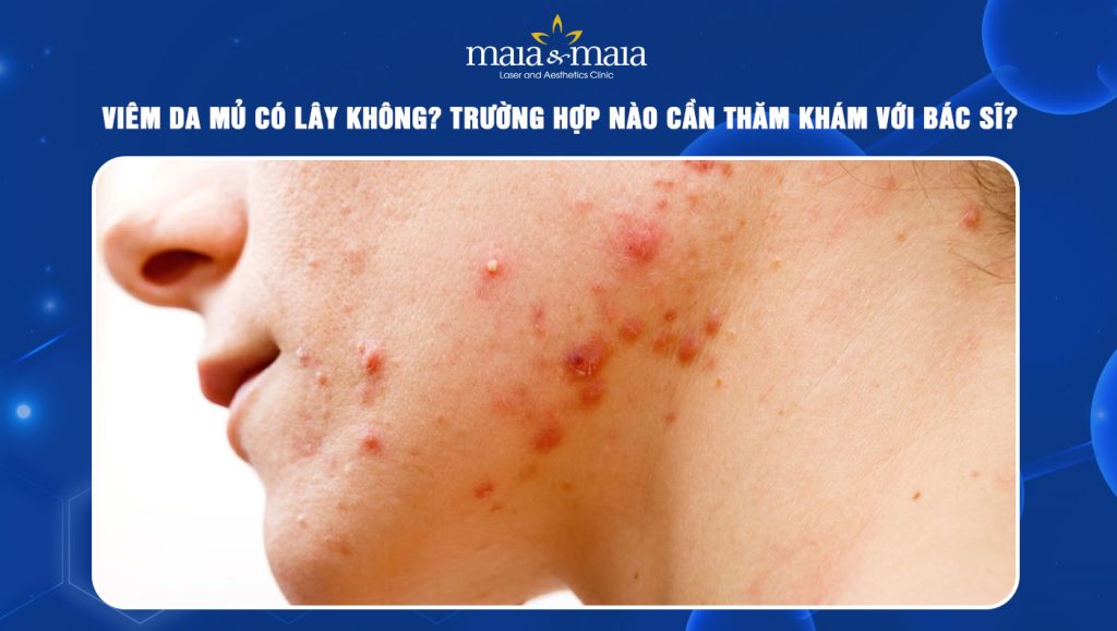 Viêm da mủ có lây không