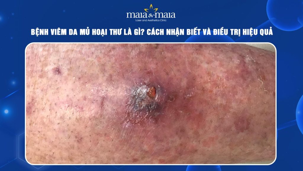 Viêm da mủ hoại thư