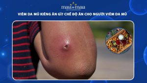 viêm da mủ kiêng ăn gì