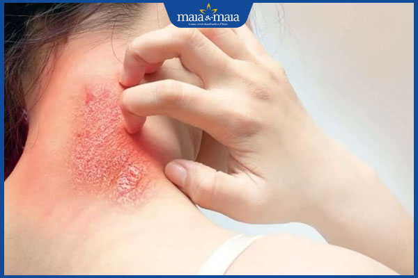 viêm da mủ lây lan