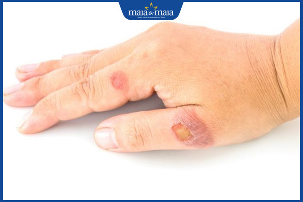 Viêm da mủ có nguy hiểm không? Nguyên nhân và cách điều trị 5 viêm da mủ tay