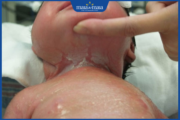 Điều trị viêm da mủ ở trẻ sơ sinh như thế nào? Làm sao để phòng bệnh? 6 viêm da mủ trẻ bong tróc