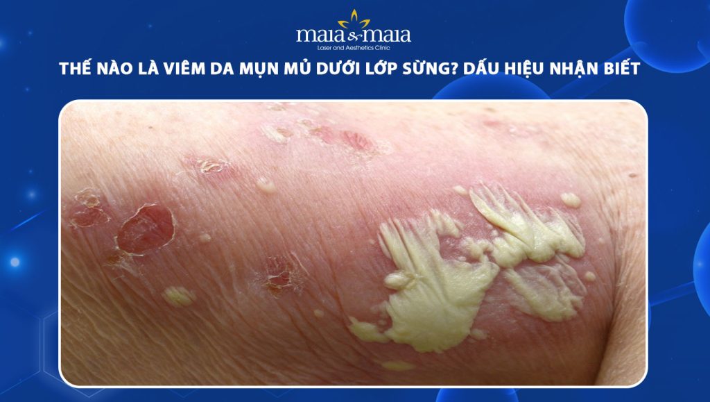 viêm da mụn mủ dưới lớp sừng