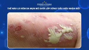 viêm da mụn mủ dưới lớp sừng