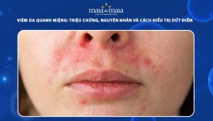 viêm da quanh miệng