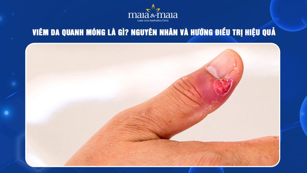 Viêm da quanh móng là gì? Nguyên nhân và hướng điều trị 1 Viêm da quanh móng