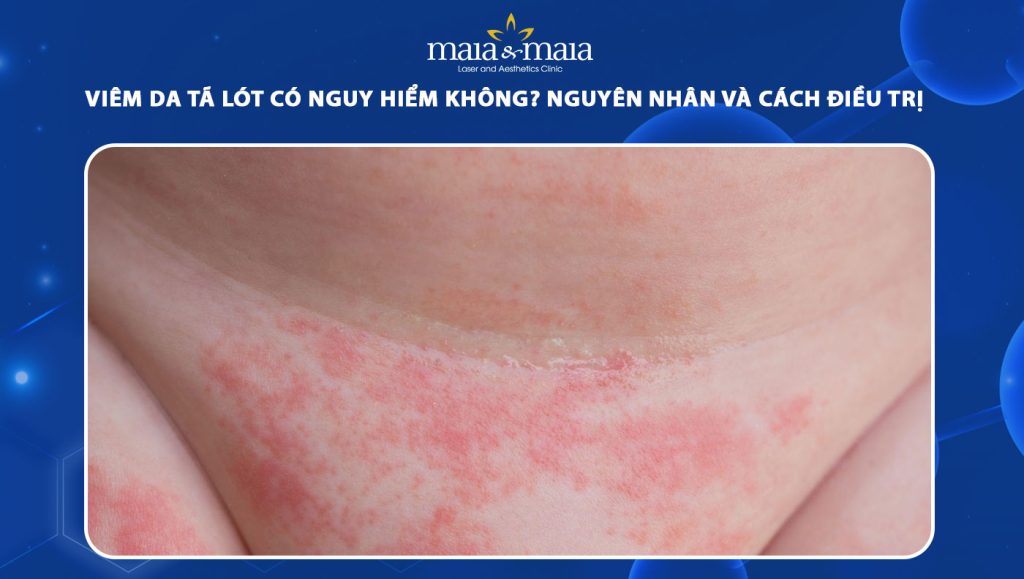Viêm da tã lót: Dấu hiệu nhận biết sớm và cách điều trị 1 viêm da tã lót