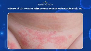 viêm da tã lót