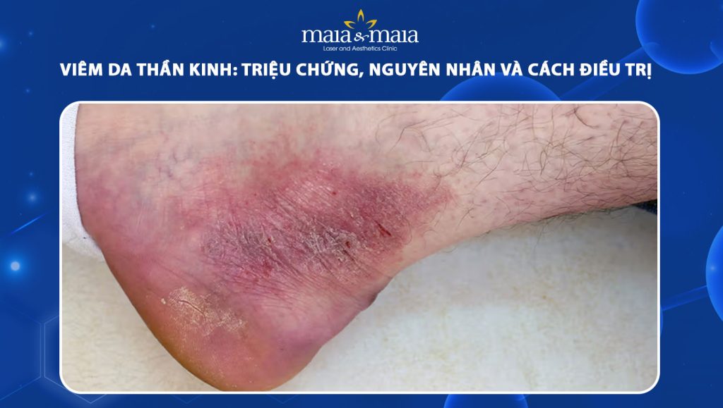 viêm da thần kinh