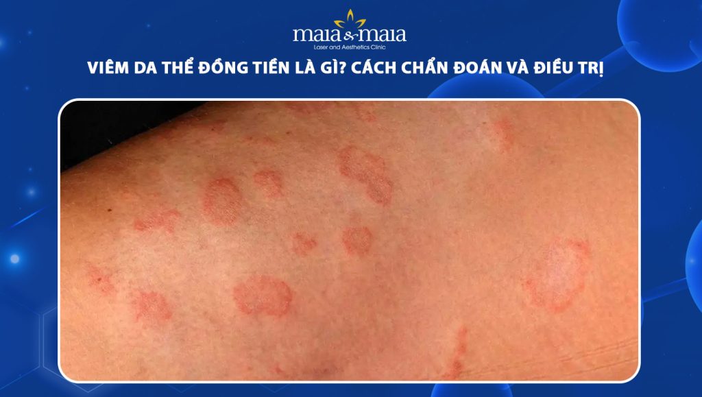 Viêm da thể đồng tiền là gì? Cách chẩn đoán và điều trị 1 viêm da thể đòng tiền