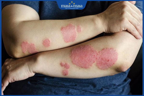 Viêm da thể đồng tiền là gì? Cách chẩn đoán và điều trị 3 viêm da thể đồng tiền lan rộng