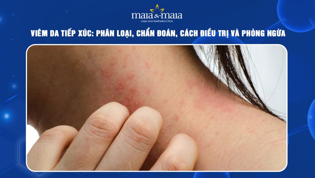 Viêm da tiếp xúc: Phân loại, chẩn đoán và cách điều trị 1 Viêm da tiếp xúc