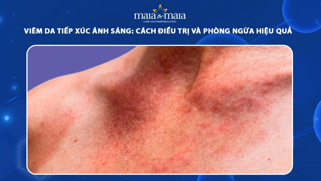 viêm da tiếp xúc ánh sáng