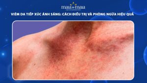viêm da tiếp xúc ánh sáng