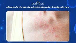 viêm da tiếp xúc bao lâu thì khỏi