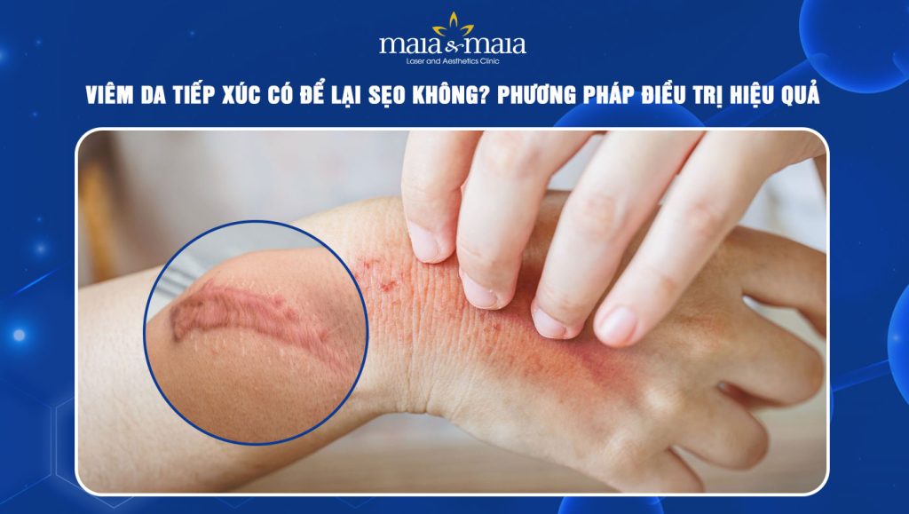 Viêm da tiếp xúc có để lại sẹo không? Phương pháp điều trị 1 Viêm da tiếp xúc có để lại sẹo không