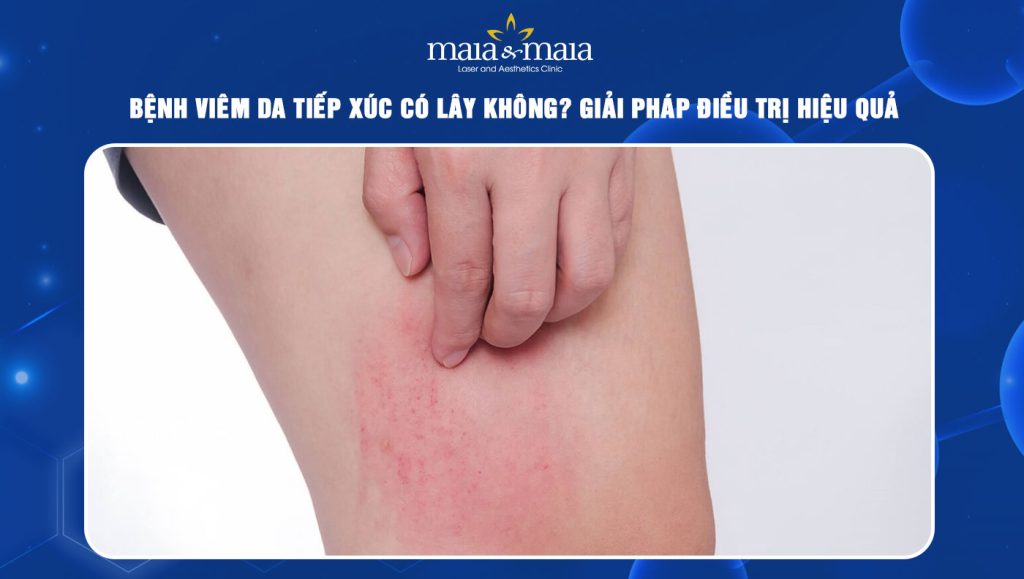 viêm da tiếp xúc có lây không