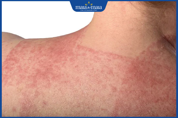 Viêm da tiếp xúc: Phân loại, chẩn đoán và cách điều trị 3 viêm da tiếp xúc cơ thể