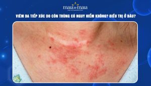 Viêm da tiếp xúc do côn trùng