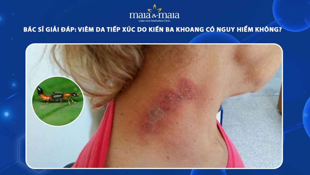 Viêm da tiếp xúc do kiến ba khoang có nguy hiểm không? 1 viêm da tiếp xúc do kiếng ba khoang