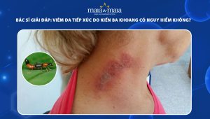 viêm da tiếp xúc do kiếng ba khoang