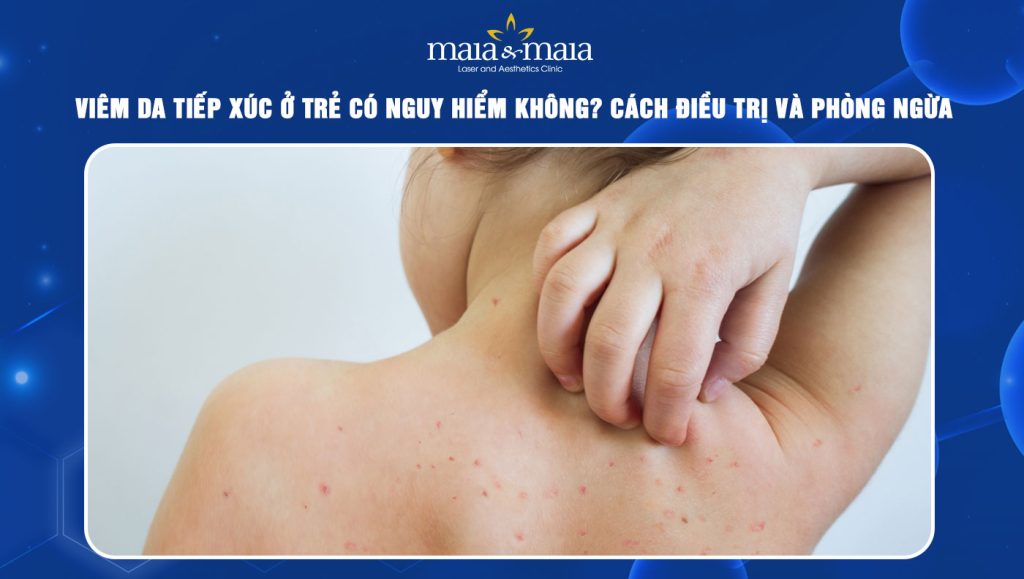 Viêm da tiếp xúc ở trẻ