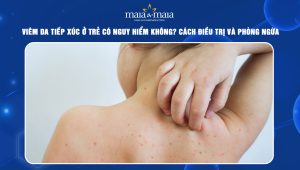 Viêm da tiếp xúc ở trẻ